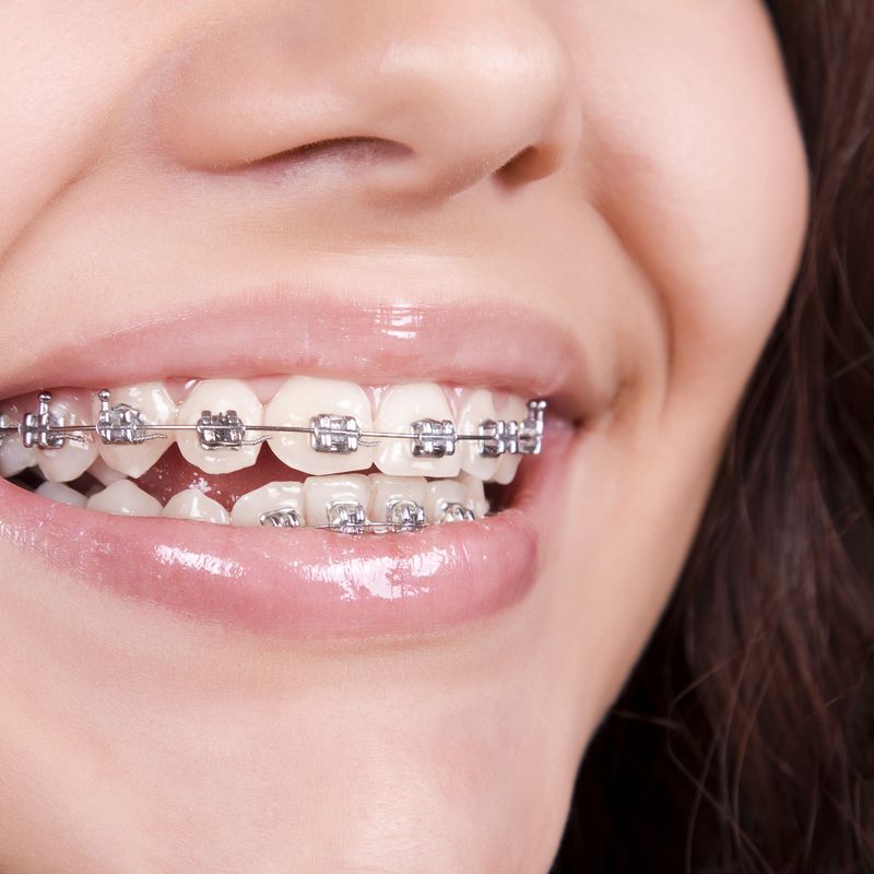 Ortodoncia: Servicios de Clínica Dental Dra. Amparo Magraner