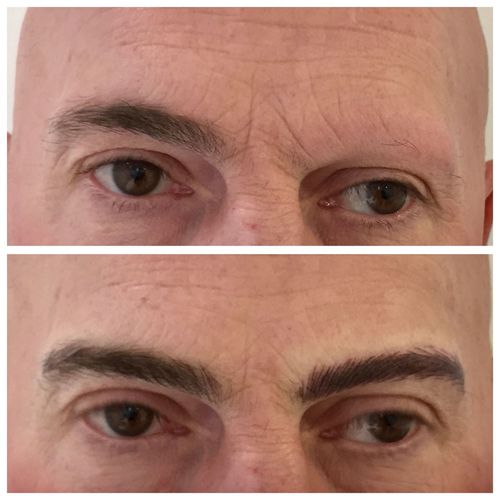 Cejas masculinas en las que se observa una alopecia total en una sola ceja...