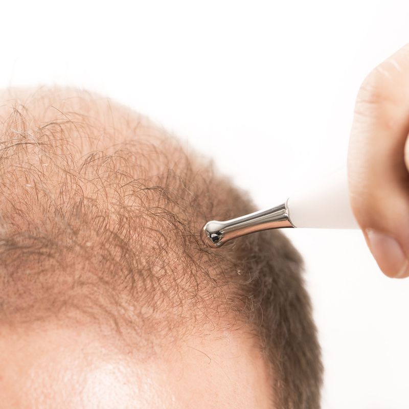 Alopecia: Dermatología y Dermoestética de Dermatología Socorro Fierro