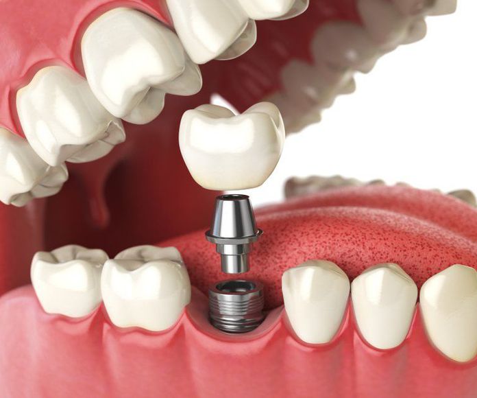 Implantes dentales: NUESTROS TRATAMIENTOS de Clínica Dental Annie Duran