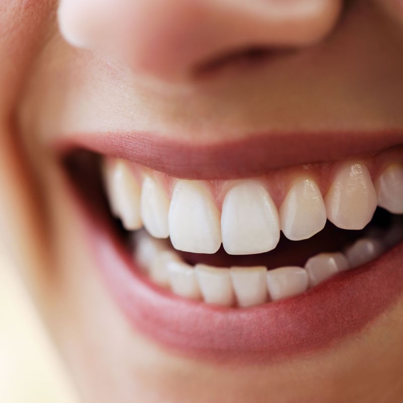 Blanqueamiento dentario: Tratamientos y Servicios de Clínica Dental Censadent