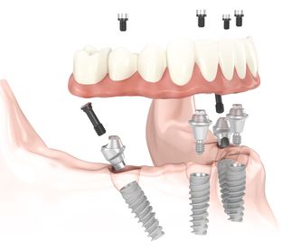Estética dental: Tratamientos de Clínica Dental García Villagrá
