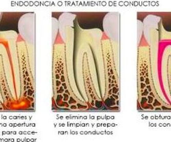 Implantes dentales: Tratamientos de Hospident Clínica Dental