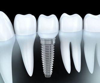 Laboratorio prótesis: Tratamientos y Servicios de Clínica Dental Censadent