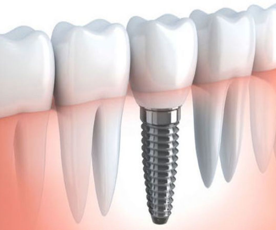 ¿Cuál es el objetivo del implante dental?