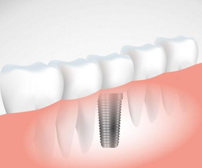 Implantes: Servicios de Clínica Dental Alodent
