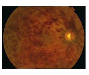 Trombosis venosa retiniana 