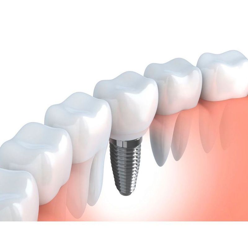 Implantología: Tratamientos dentales de MARÍA JOSÉ CLOLS FERRER