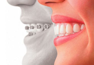 Ortodoncia estética