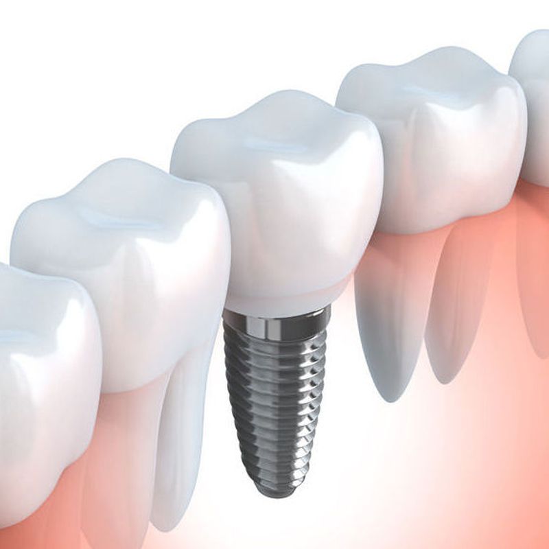 Implantes dentales: Tratamientos de Clínica Dental Dra. Carretero