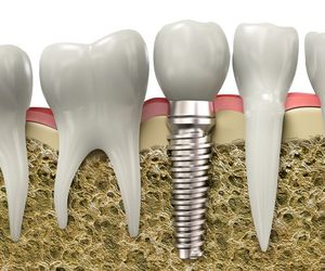 ¿Cómo se sujetan los implantes dentales?