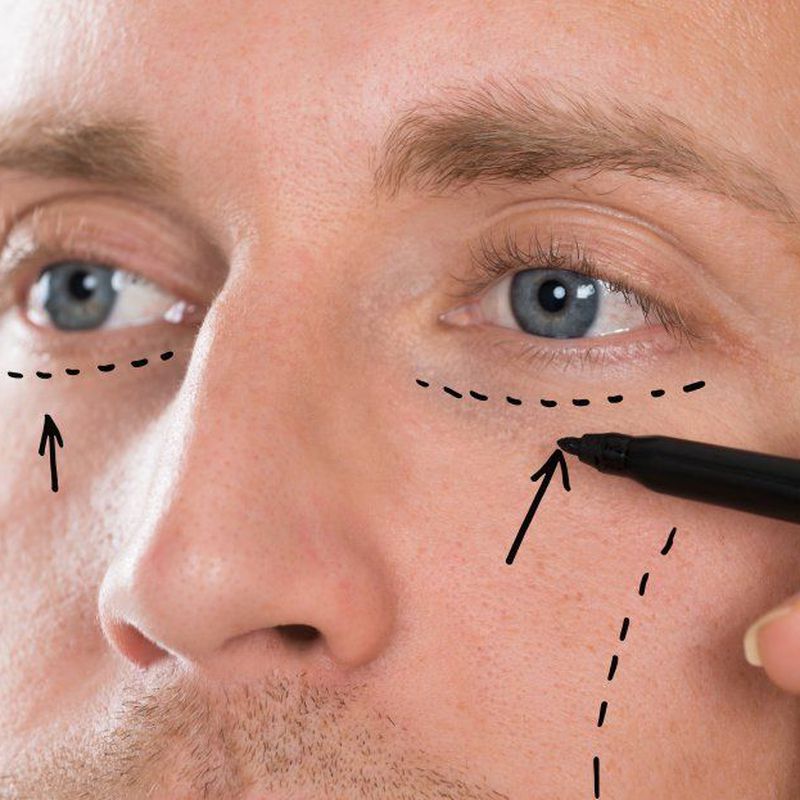 Blefaroplastia: Cirugías de Vicente García Morato Jorreto