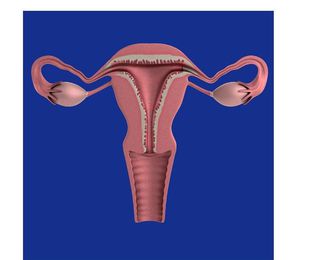 Extirpación radical del útero con linfadenectomía