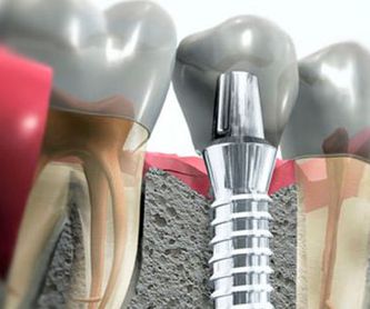 Periodoncia: Tratamientos de Centro Dental Europa