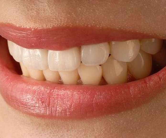 Carillas estéticas: Tratamientos de Clínica Dental Humanes 61