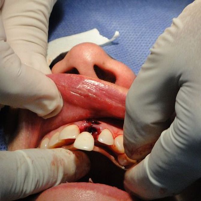 Lo que debes saber acerca de los implantes dentales