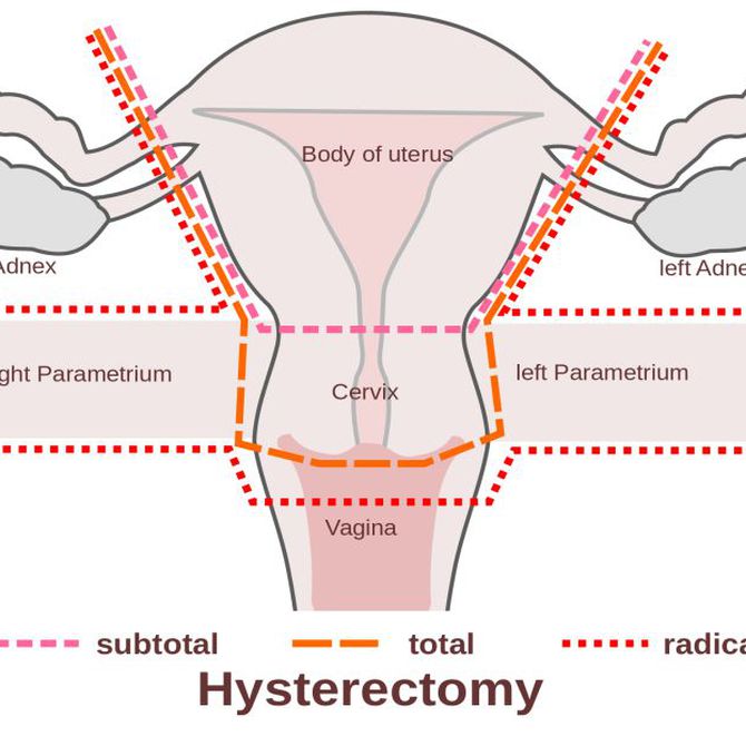 Qué es la histerectomía