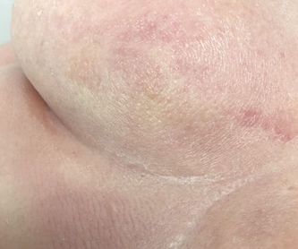 Relleno de Ácido Hialurónico: Dermatología y Dermoestética de Dermatología Socorro Fierro
