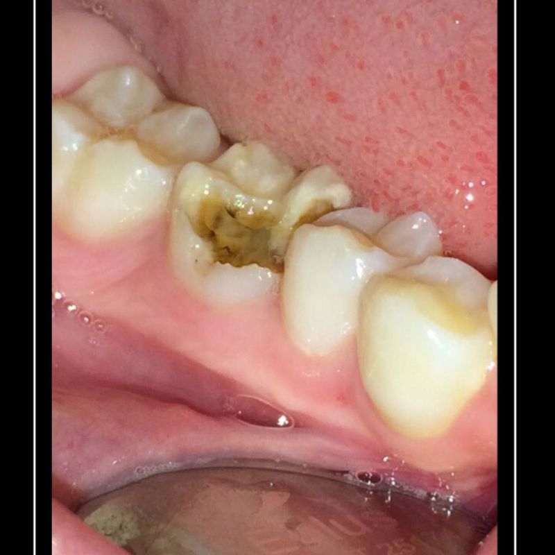 Empastes: Tratamientos de Clínica Dental Tucán