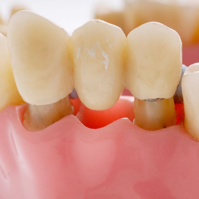 Todo lo que debes saber sobre los implantes dentales