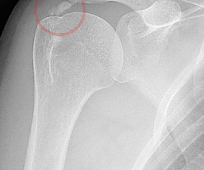 Tendinitis: Tratamientos de Pacientes particulares