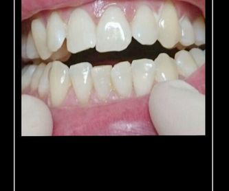 Corona metal porcelana: Tratamientos de Clínica Dental Tucán