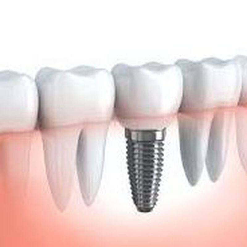 Implantología: Tratamientos de Centre Dental Oddo