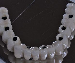 Implantes dentales en Ciudad Lineal