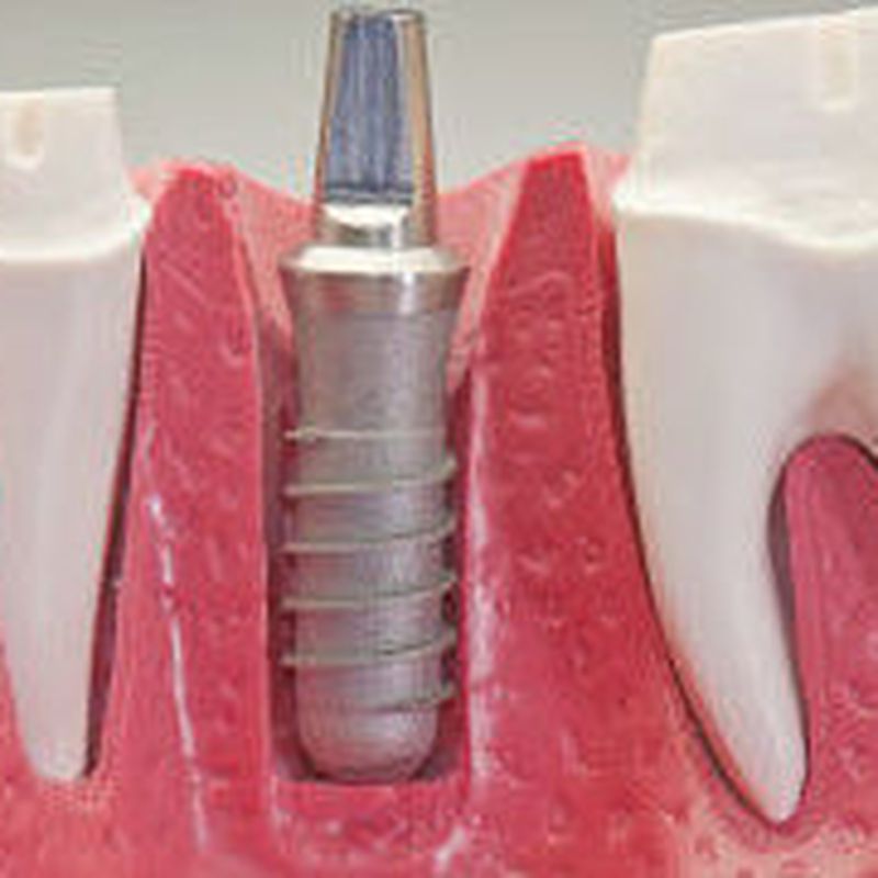 Implantes dentales: Tratamientos y tecnología de Clínica Dental Daniel Molina