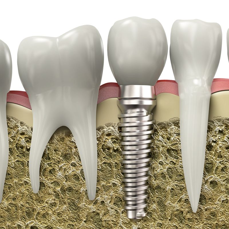 Implantes: Servicios  de Clínica Dental Cadillon
