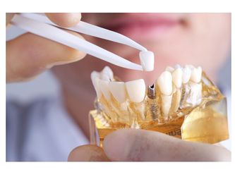 Prótesis dentales: Servicios de Clínica Dental Olivier Houdusse