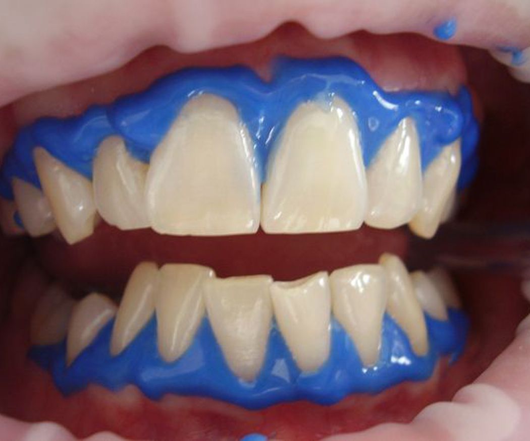 Todo lo que necesitas saber sobre el blanqueamiento dental