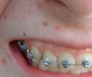 La importancia de la higiene oral en tratamientos de ortodoncia fija