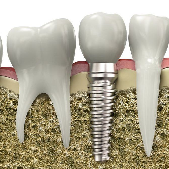 Falsos mitos sobre implantes dentales