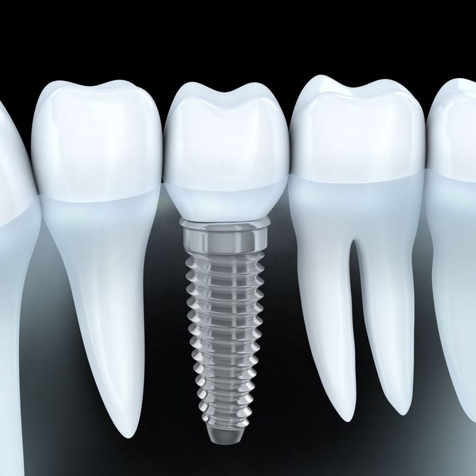¿Por qué ponerse implantes dentales?
