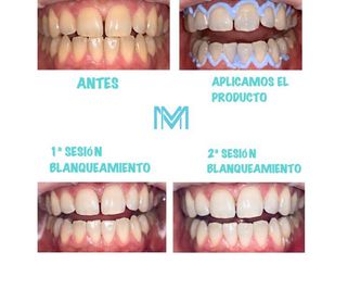 Prótesis dentales: Servicios de Marta Martínez Clínica Dental