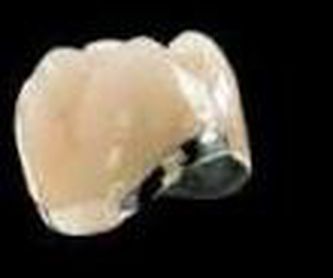 Implantes: Tratamientos de Clínica Dental Tucán