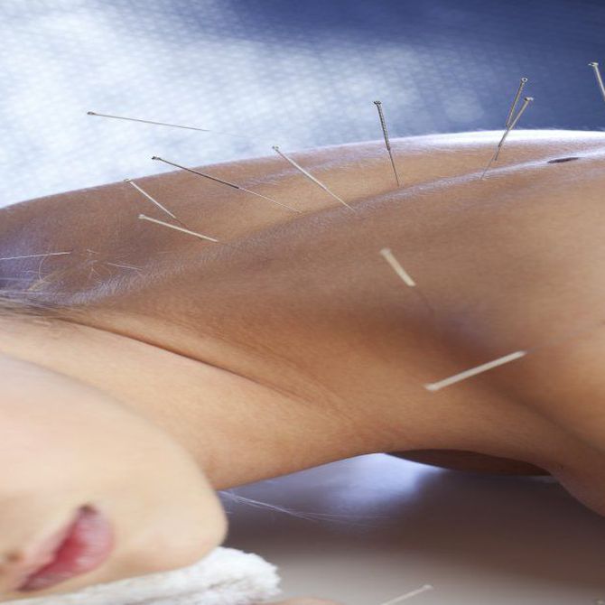 La acupuntura para adelgazar (I)