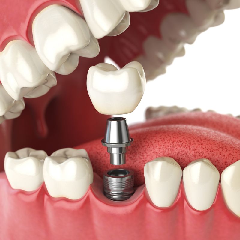 implantes dentales.jpg