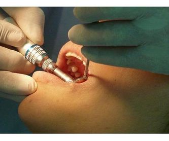 Implantes: Tratamientos de Lucía González Botana