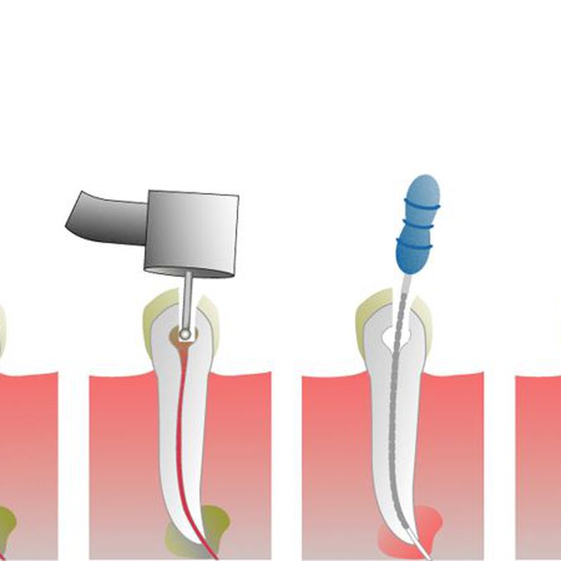 Endodoncia: Especialidades de Clínica Dental Virgen de la Victoria. Dr. Leopoldo Hernández