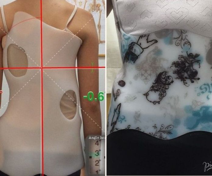 Nuevos diseños para corses de tratamiento de escoliosis y cifosis