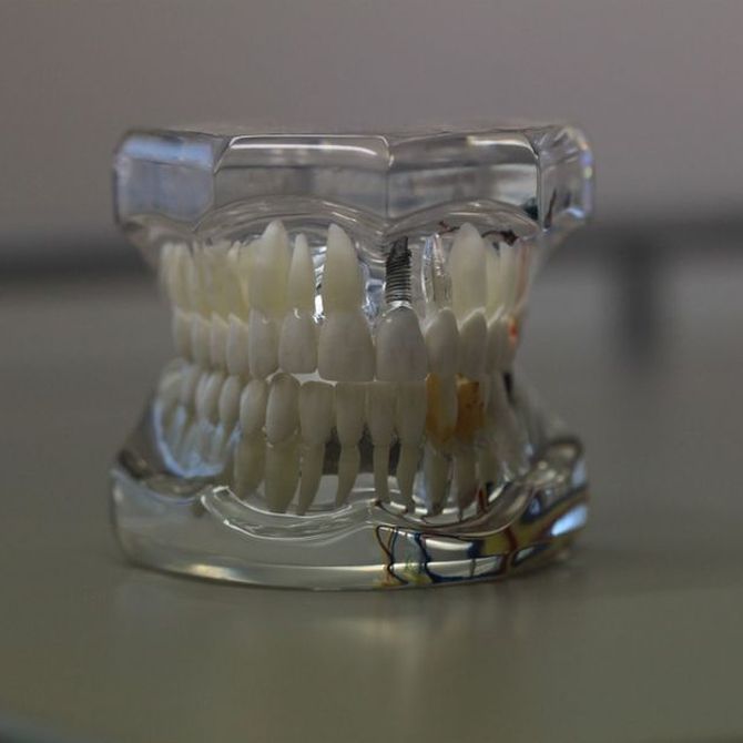 Las prótesis dentales