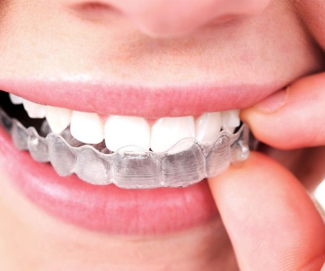 Cuidados para pacientes con ortodoncia invisible