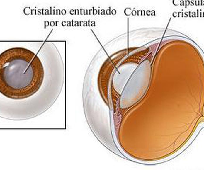 Tratamiento de la Catarata: Servicios de Dr. Alfonso Piñero