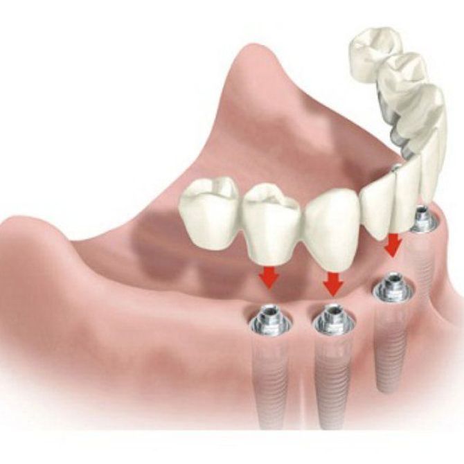 Implantes dentales: lo más parecido a tu pieza natural