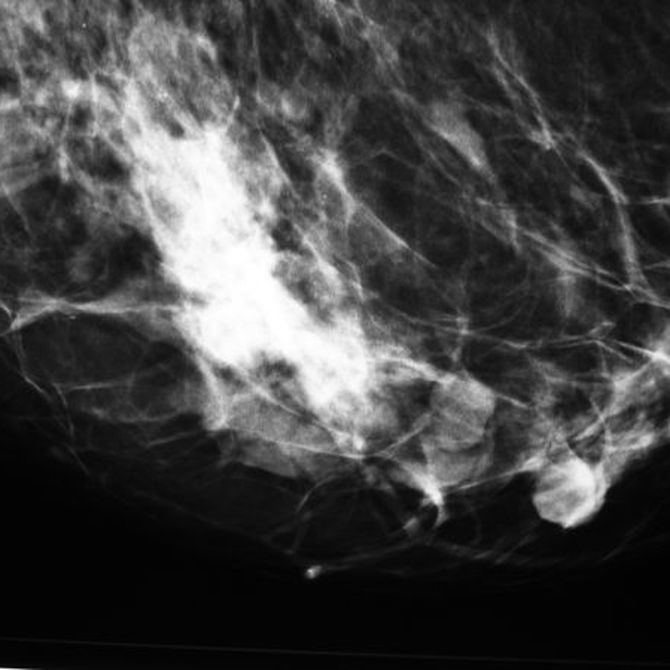 ¿Qué diferencia una mamografía de una ecografía de mamas?
