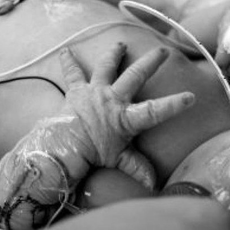 Fisioterapia desde neonatos