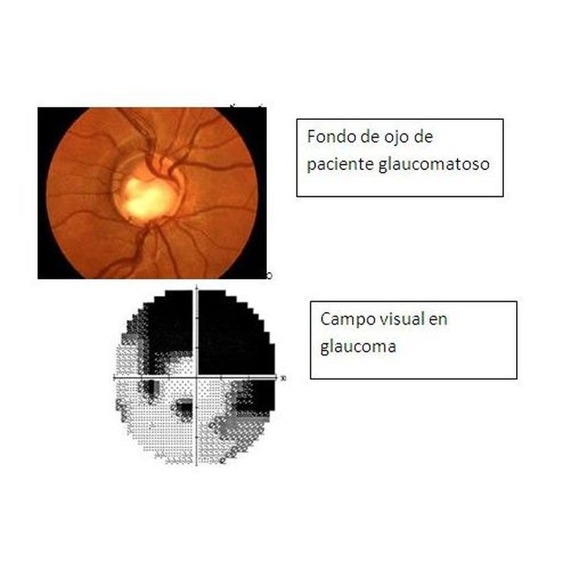 Glaucoma: Patologías oculares de Oftalmólogo Cristina Mantolán Sarmiento
