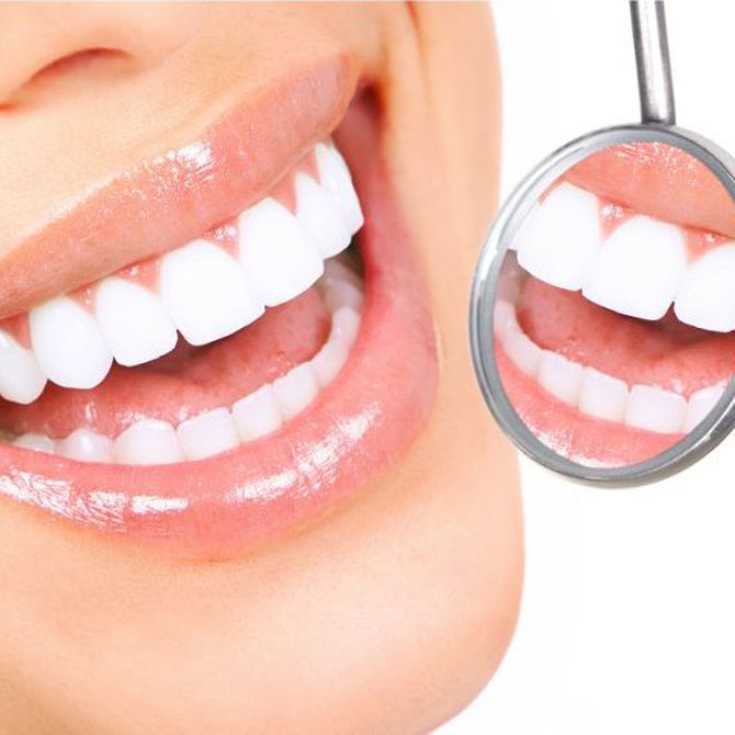 Las 5 preguntas más frecuentes sobre el blanqueamiento dental